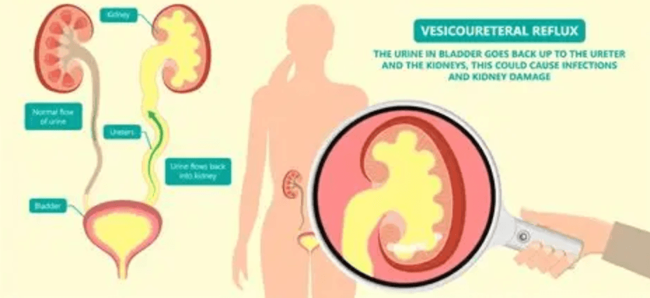 Vesicoureteral Reflux